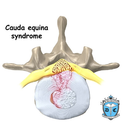 Illustration of Cauda equina syndrome.