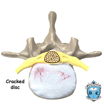 Illustration of a cracked disc.