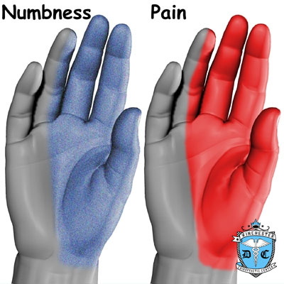 Illustration of CTS Numbness and Pain.