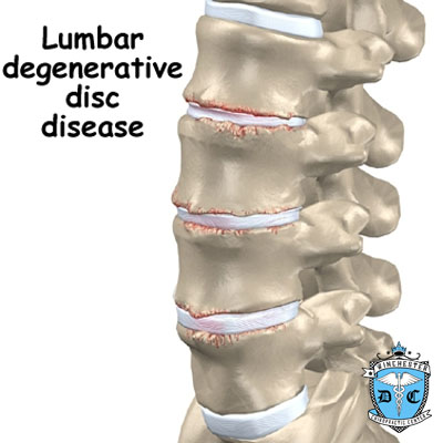 Illustration of lumbar degenerative disc disease.