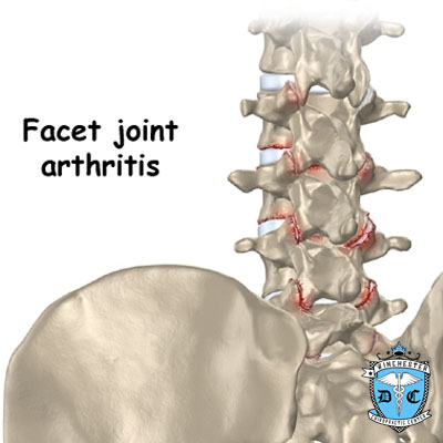 Illustration of facet joint arthritis.