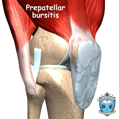 Illustration of knee bursitis.