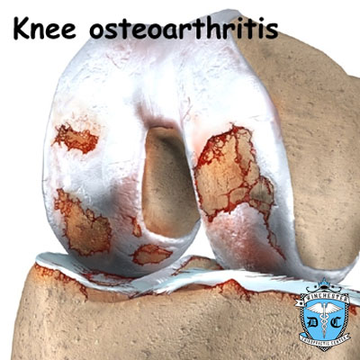 Illustration of knee osteoarthritis.