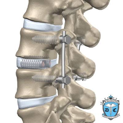 Illustration of lumbar degenerative disc disease surgery.