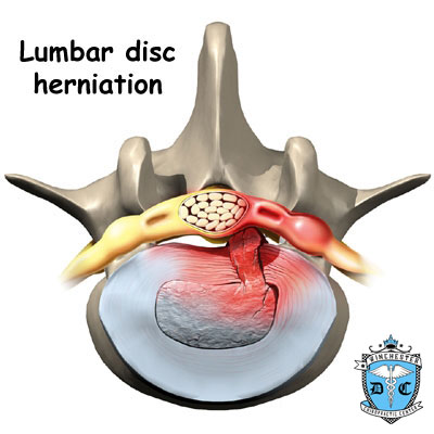 Illustration of lumbar disc herniation.