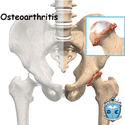Illustration of osteoarthritis.
