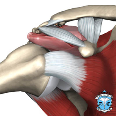 Illustration of shoulder impingement.