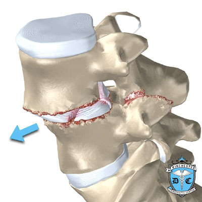Illustration of the cause of spondylolisthesis.