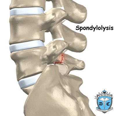Illustration of spondylolysis.