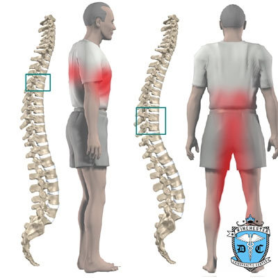 Illustration of thoracic-disc-herniation symptom areas.