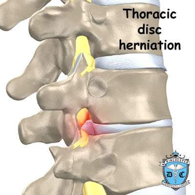Illustration of thoracic-disc-herniation.